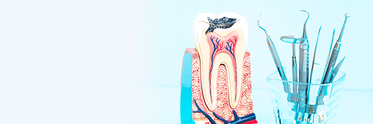 虫歯治療