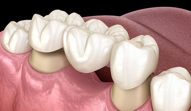 保険診療のブリッジ