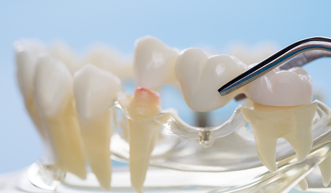 自費診療のブリッジ