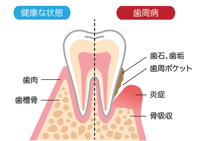 歯周病とは